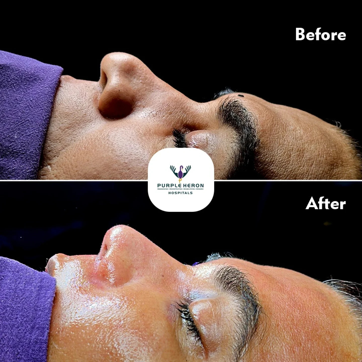 Rhinoplasty Surgery in Jaipur