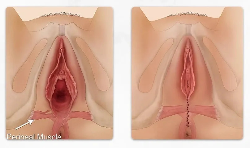 Vaginoplasty Surgery in Jaipur