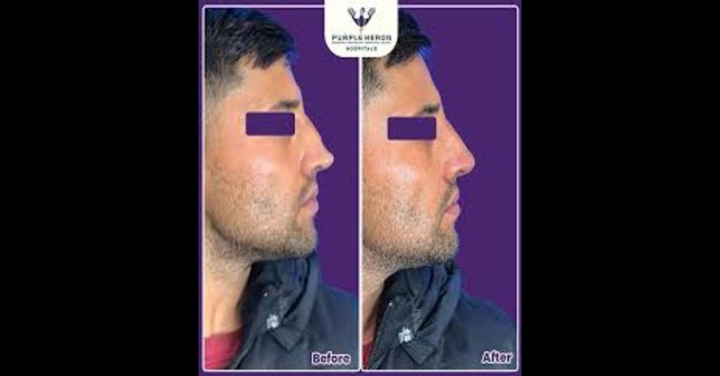 Rhinoplasty Surgery cost in Jaipur