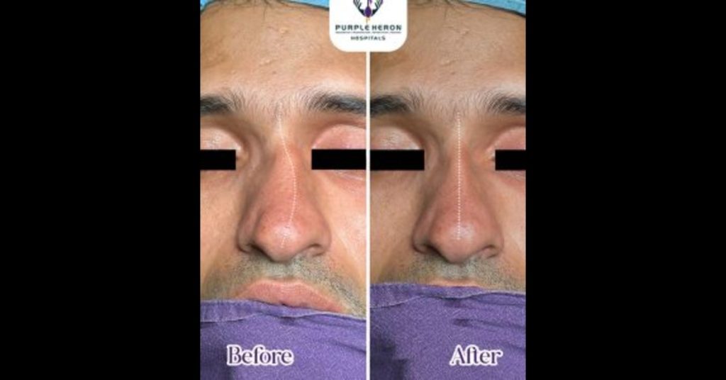 Rhinoplasty Surgery cost in Jaipur