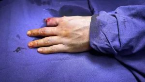 Supermicrosurgery in India