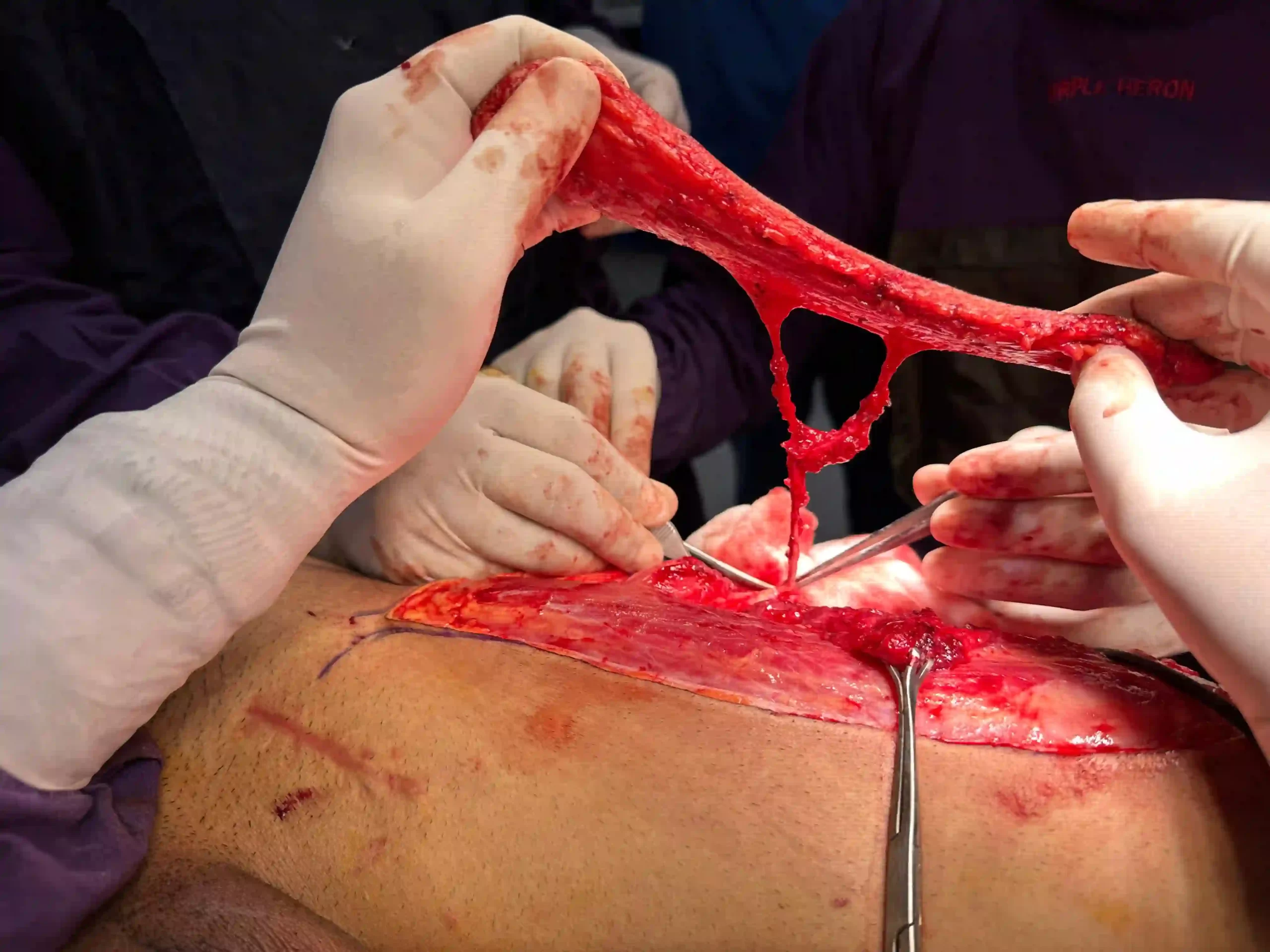 Supermicrosurgery in India