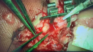 Supermicrosurgery in India