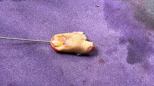 Supermicrosurgery in India