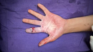 Supermicrosurggery in India