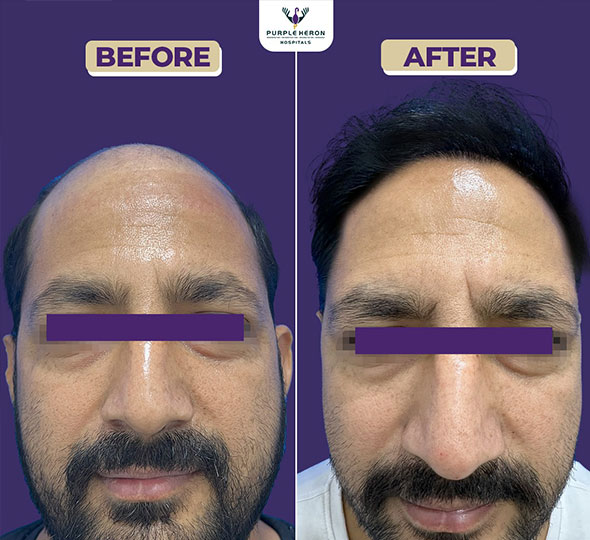 Best Hair Transplant in Jaipur