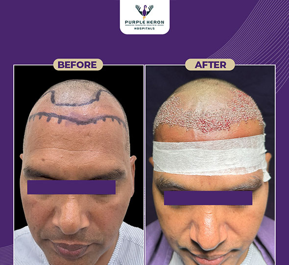 Best Hair Transplant in Jaipur