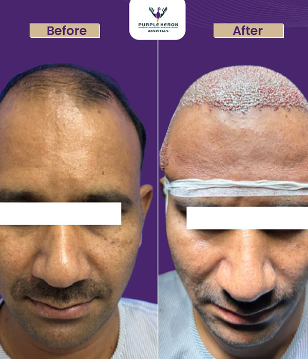 Best Hair Transplant in Jaipur