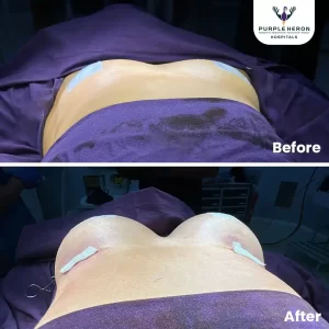 Breast Surgery in Jaipur