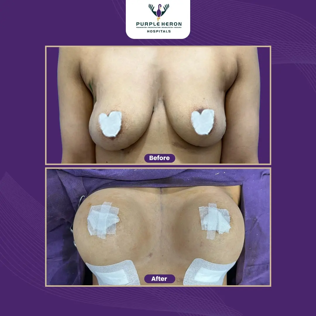 Breast Surgery in Jaipur