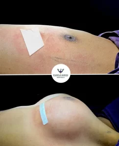 Breast Surgery in Jaipur