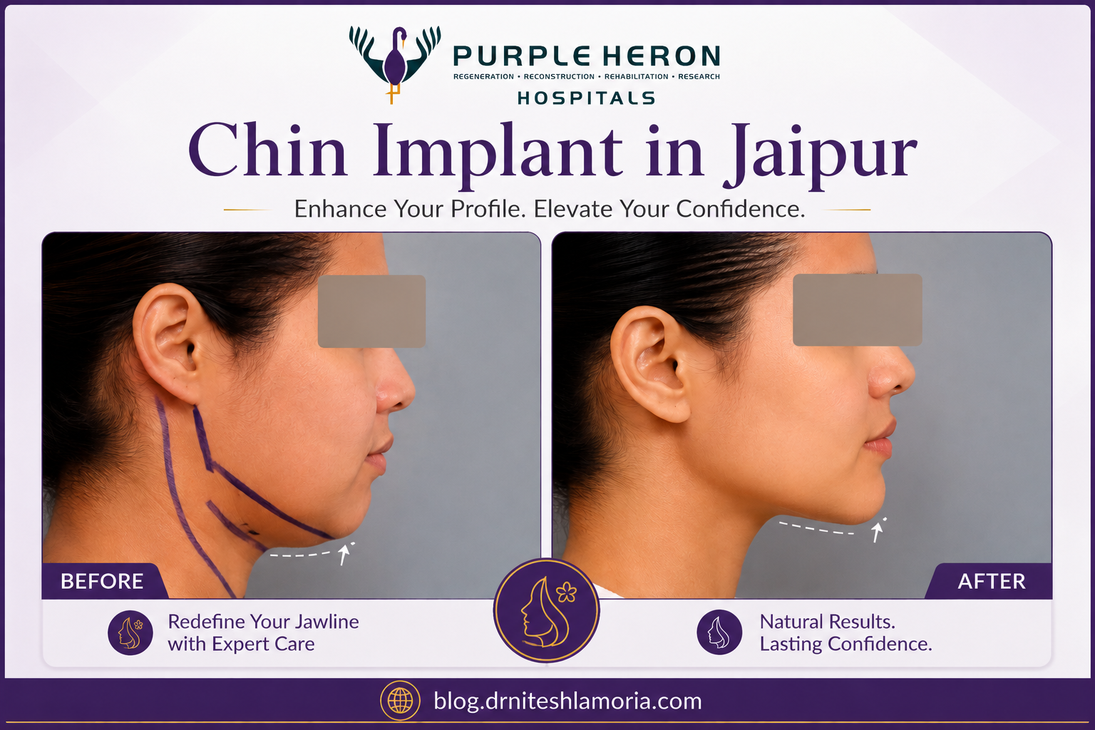 Chin Implant in Jaipur