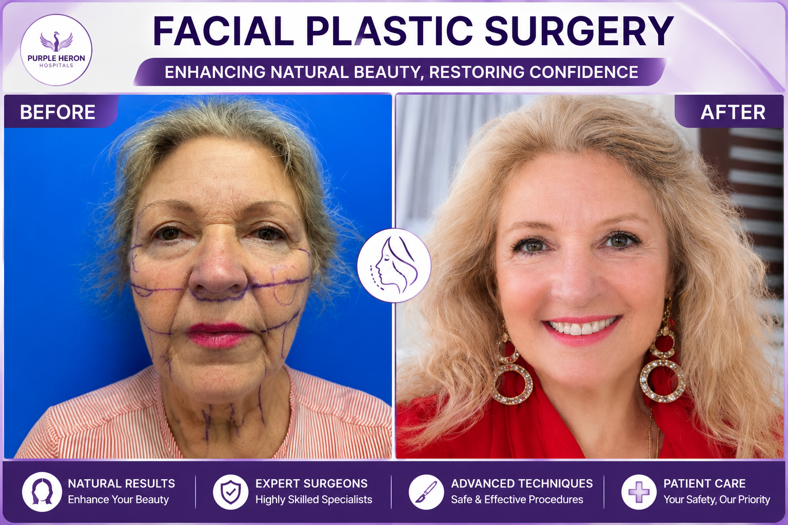 Facial Plastic Surgery in India
