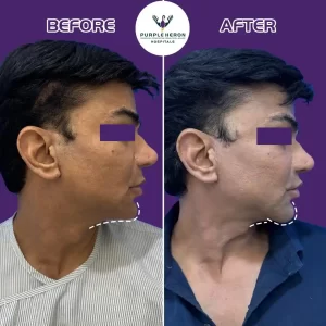 Facial Plastic Surgery in India