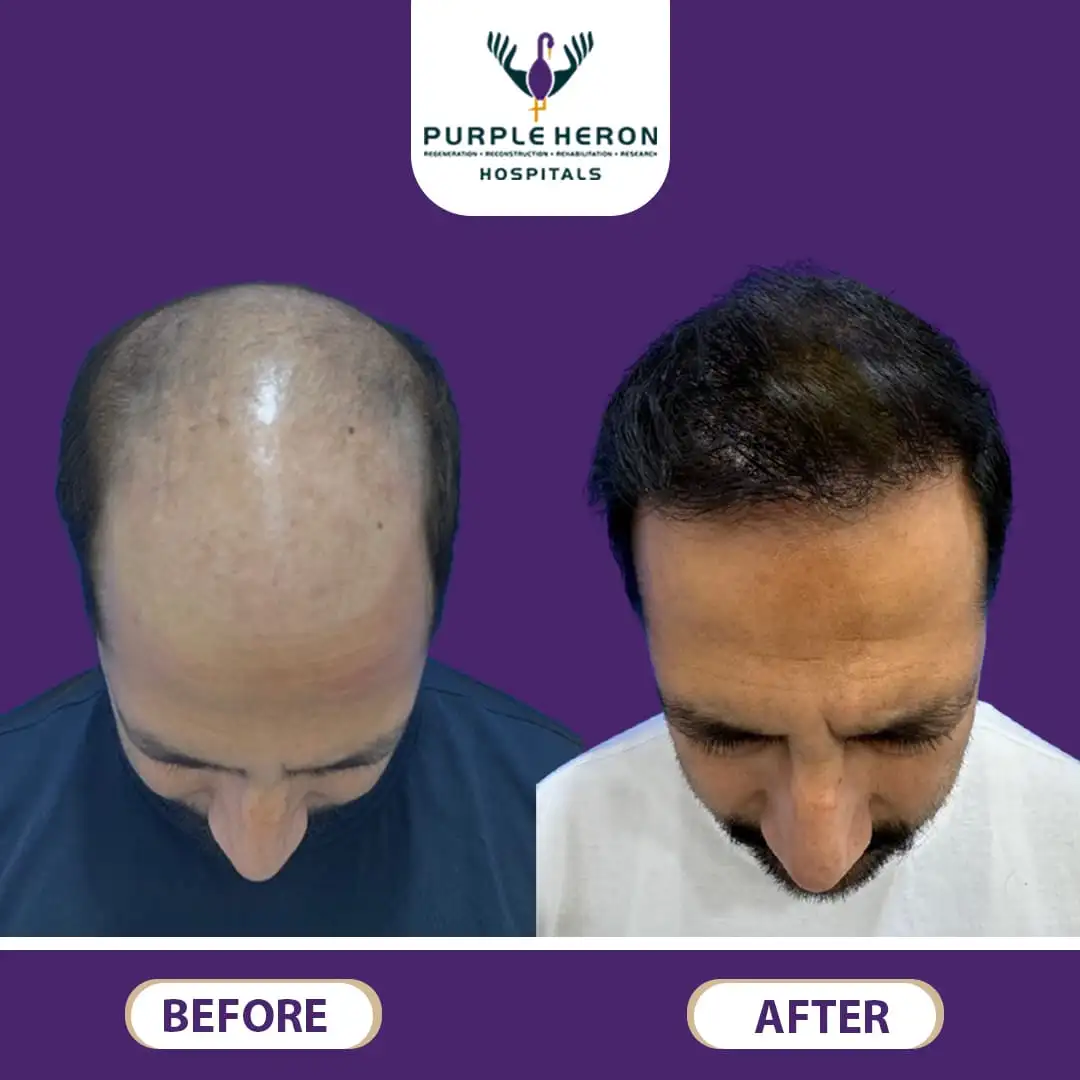 Hair Transplants Doctor in Jaipur