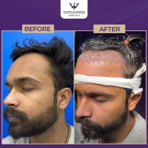 Hair Transplants Doctor in Jaipur