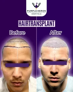 Hair Transplants Doctor in Jaipur