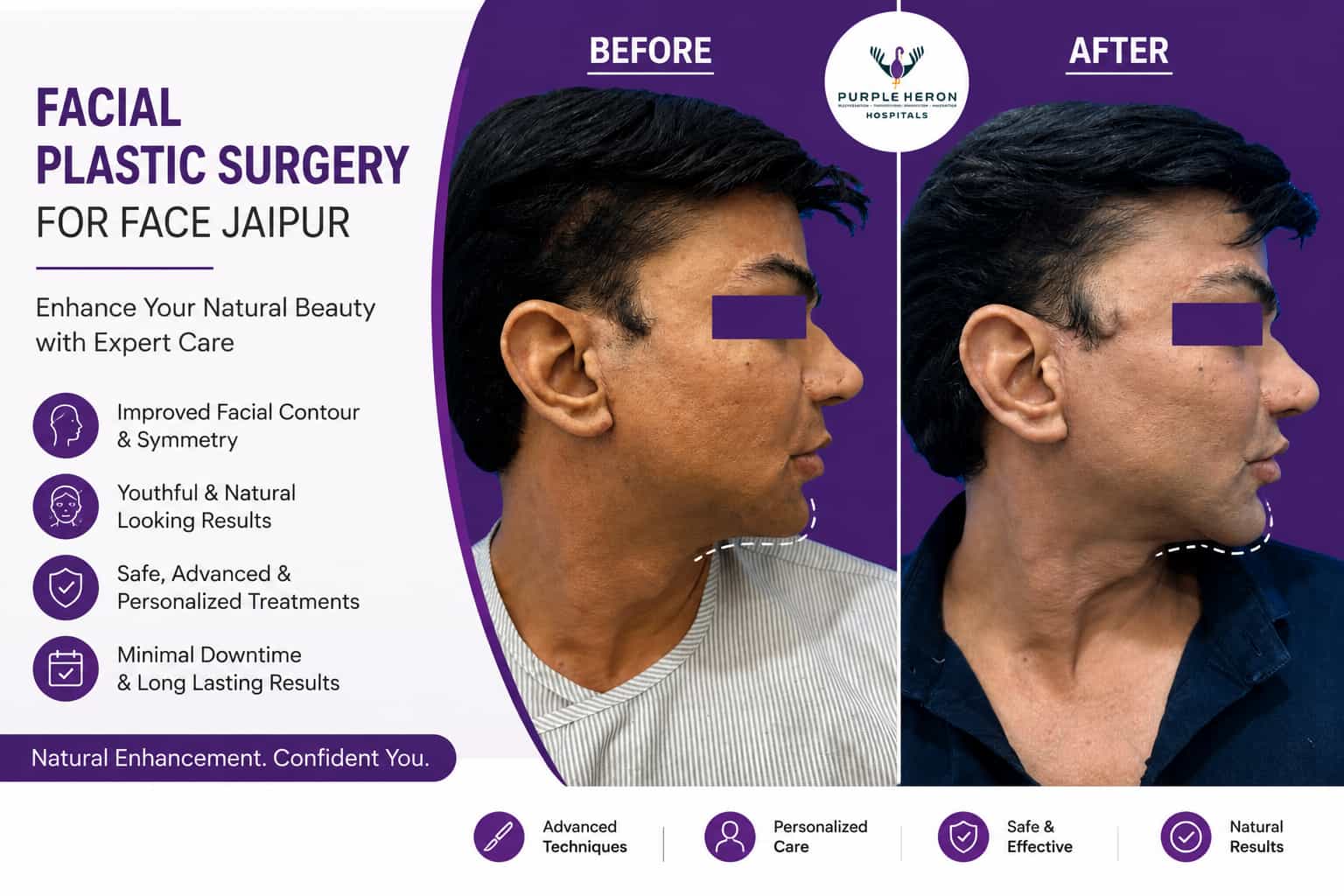 Plastic Surgery For Face Jaipur