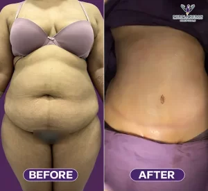 Top 10 mommy makeover surgery in Jaipur