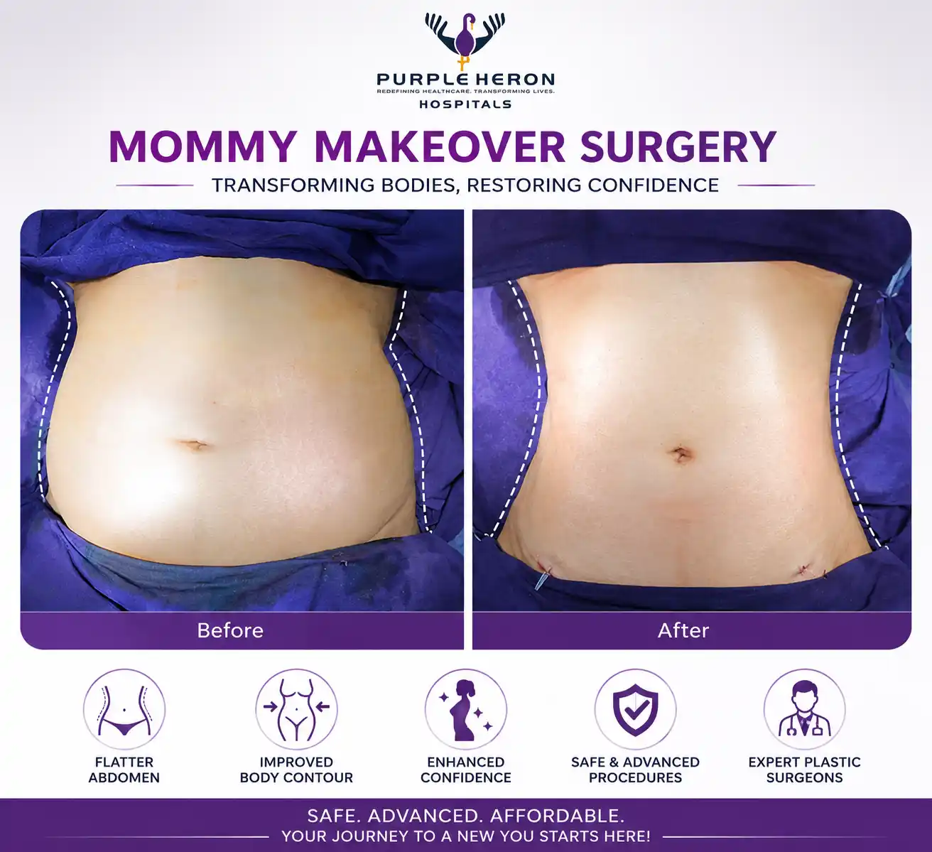 Top 10 mommy makeover surgery in Jaipur
